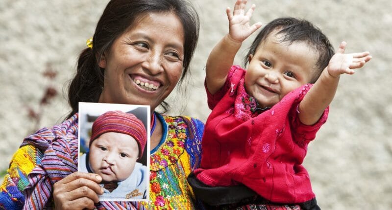 Operación Sonrisa devuelve esperanza con cirugías gratuitas